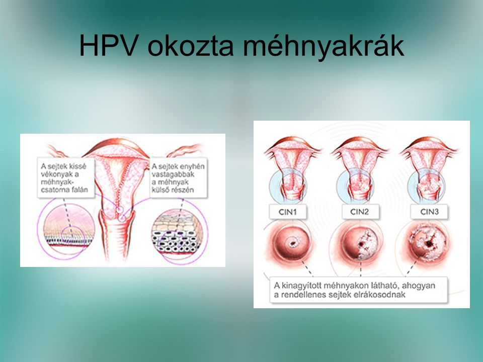 HPV okozta méhnyakrák