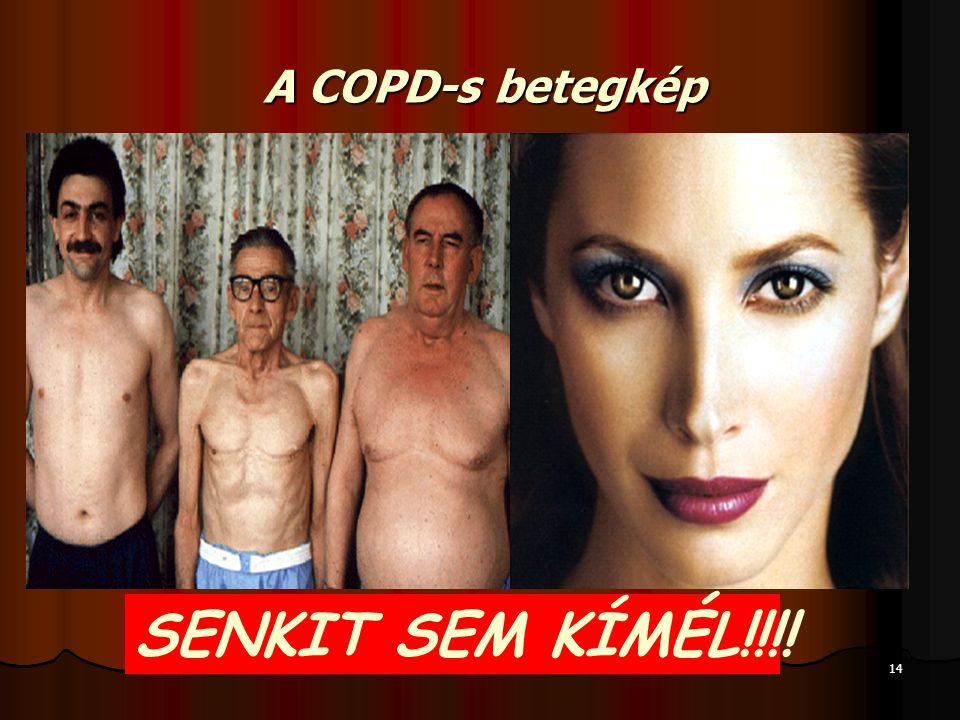 A COPD-s betegkép SENKIT SEM KÍMÉL!!!!