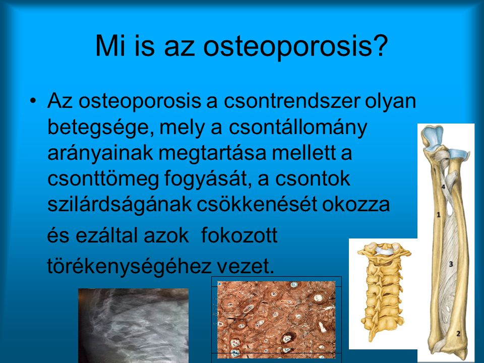 Mi is az osteoporosis