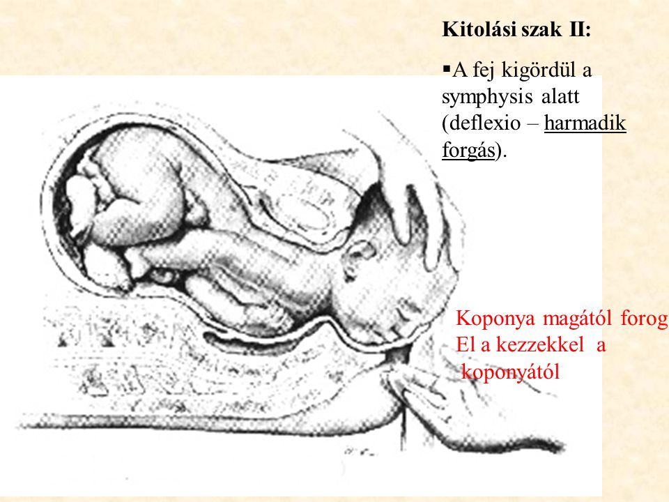 Kitolási szak II: A fej kigördül a symphysis alatt (deflexio – harmadik forgás). Koponya magától forog.