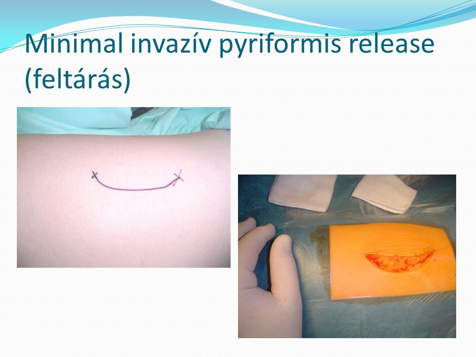 Minimal invazív pyriformis release (feltárás)