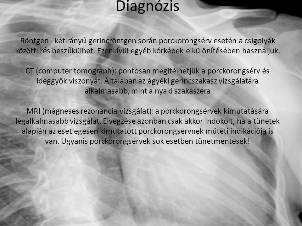 Diagnózis Röntgen - kétirányú gerincröntgen során porckorongsérv esetén a csigolyák közötti rés beszűkülhet.