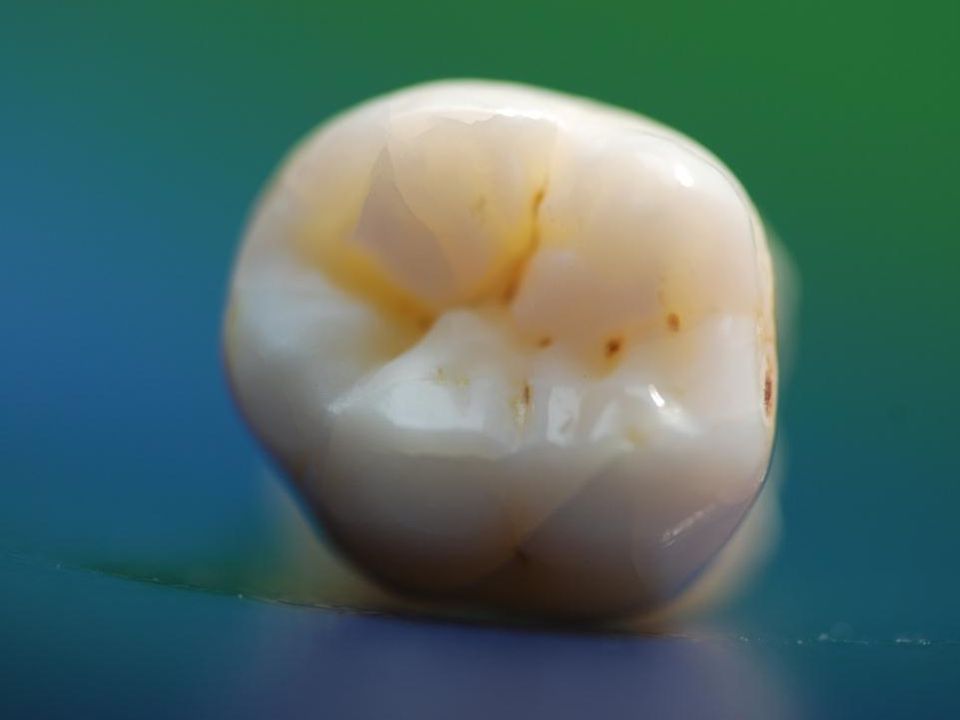 Molaris fogak helyreállításának modern technikái