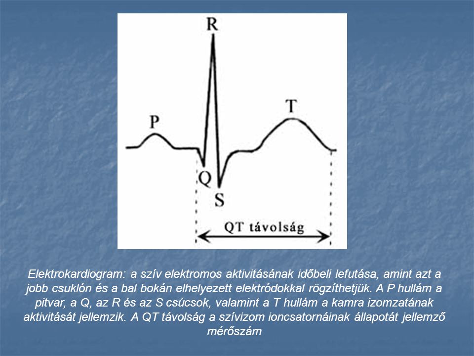 Elektrokardiogram: a szív elektromos aktivitásának időbeli lefutása, amint azt a jobb csuklón és a bal bokán elhelyezett elektródokkal rögzíthetjük.