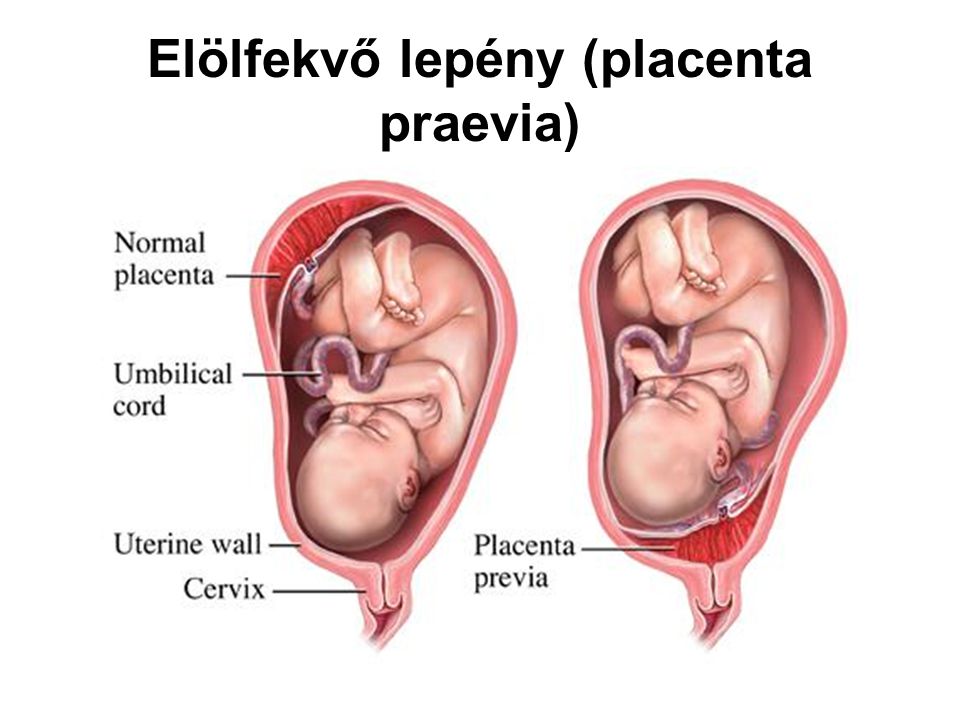 Elölfekvő lepény (placenta praevia)