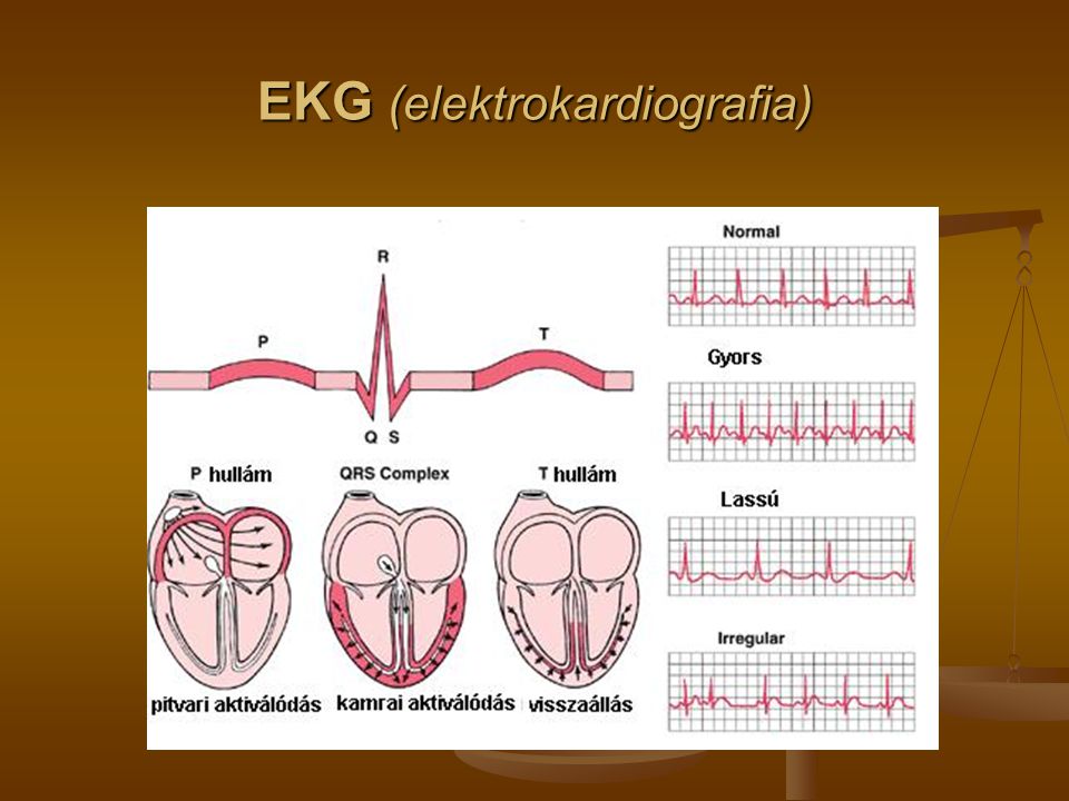 EKG (elektrokardiografia)