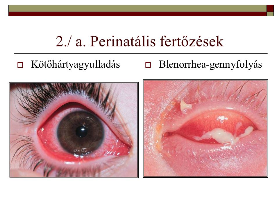 2./ a. Perinatális fertőzések