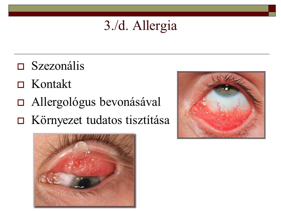 3./d. Allergia Szezonális Kontakt Allergológus bevonásával