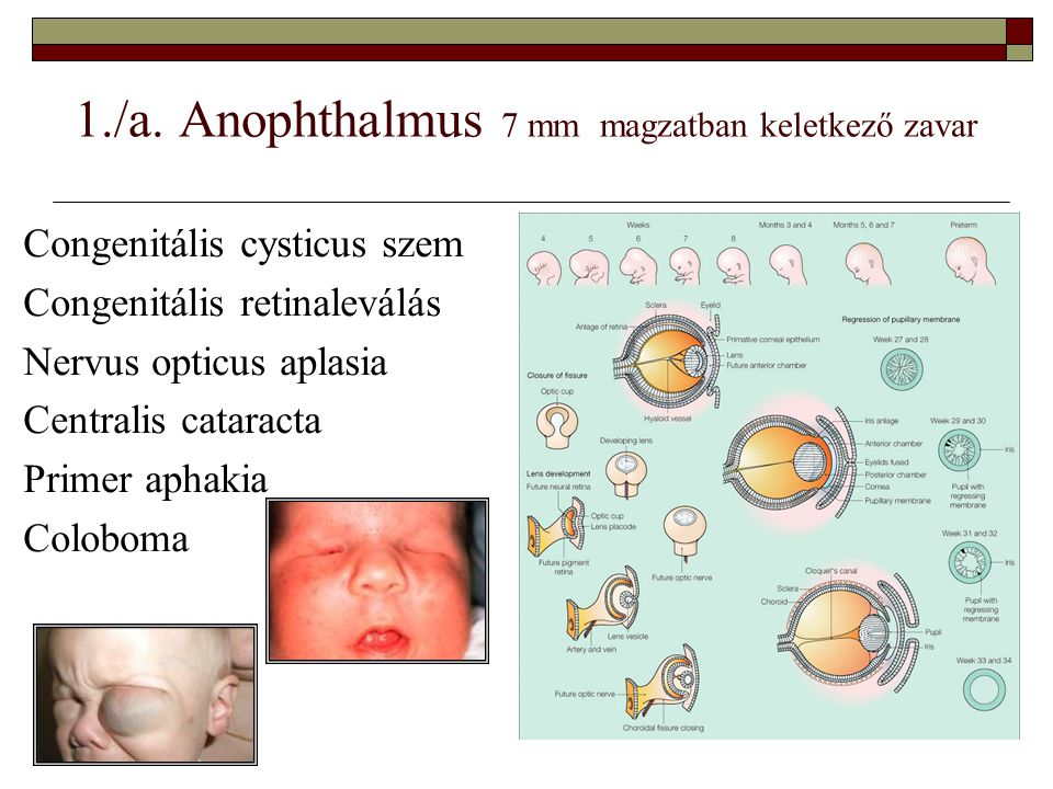1./a. Anophthalmus 7 mm magzatban keletkező zavar