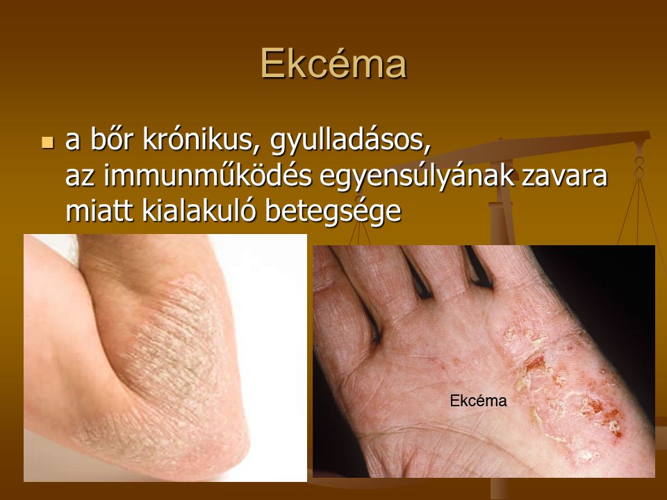 Ekcéma a bőr krónikus, gyulladásos, az immunműködés egyensúlyának zavara miatt kialakuló betegsége