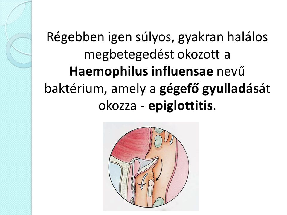 Régebben igen súlyos, gyakran halálos megbetegedést okozott a Haemophilus influensae nevű baktérium, amely a gégefő gyulladását okozza - epiglottitis.