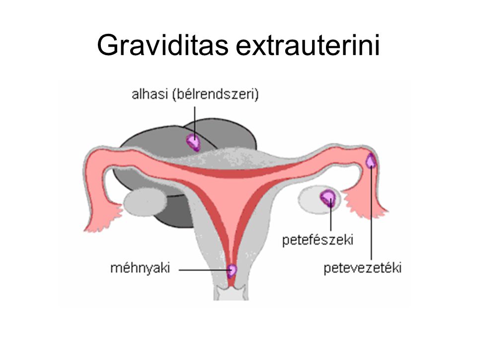 Graviditas extrauterini