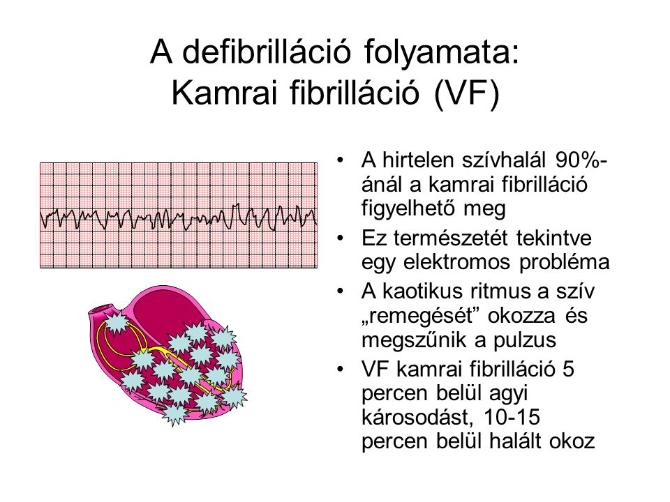 A defibrilláció folyamata: Kamrai fibrilláció (VF)