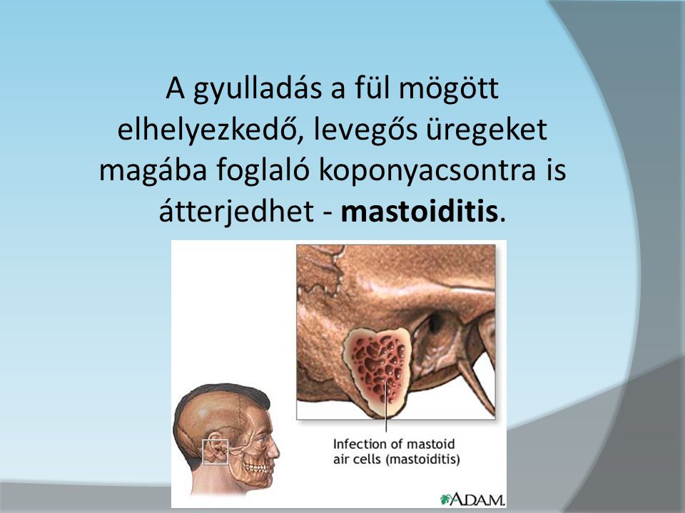A gyulladás a fül mögött elhelyezkedő, levegős üregeket magába foglaló koponyacsontra is átterjedhet - mastoiditis.