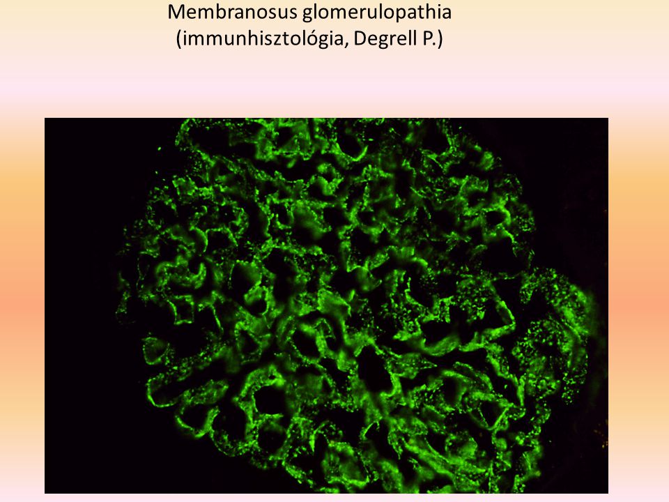 Membranosus glomerulopathia (immunhisztológia, Degrell P.)