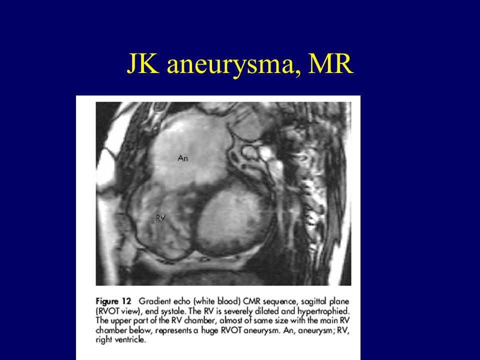 JK aneurysma, MR