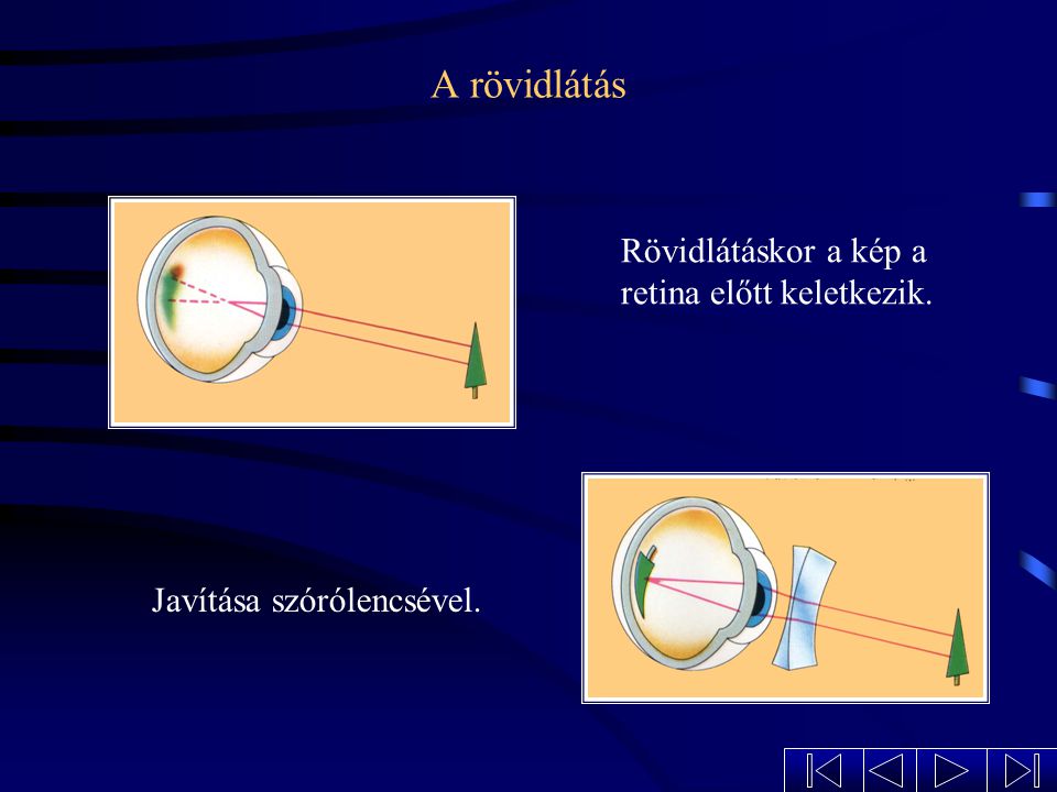 A rövidlátás Rövidlátáskor a kép a retina előtt keletkezik.