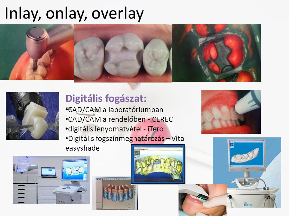 Inlay, onlay, overlay Digitális fogászat: CAD/CAM a laboratóriumban