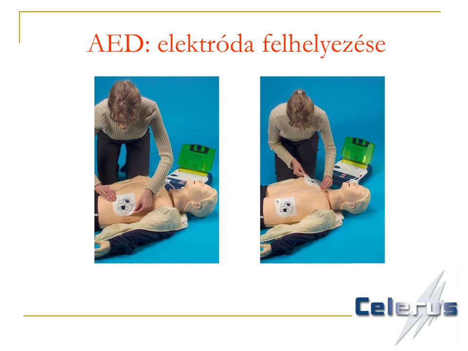 AED: elektróda felhelyezése