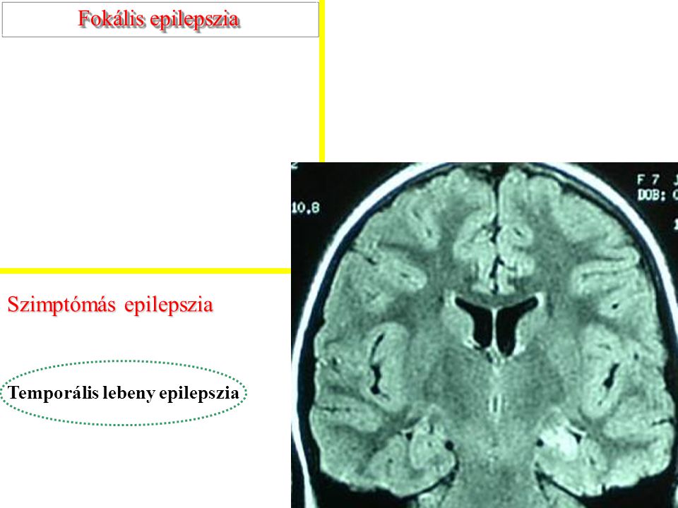 Szimptómás epilepszia