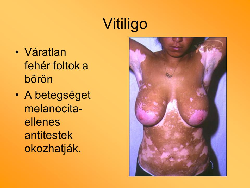 Vitiligo Váratlan fehér foltok a bőrön
