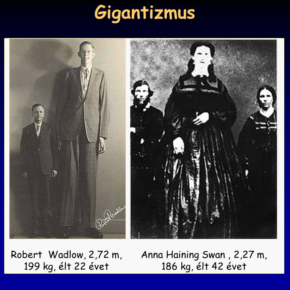 Gigantizmus Robert Wadlow, 2,72 m, 199 kg, élt 22 évet