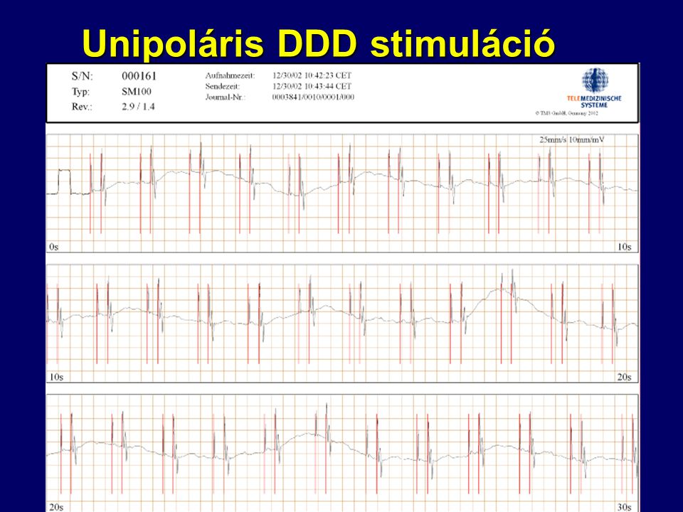 Unipoláris DDD stimuláció