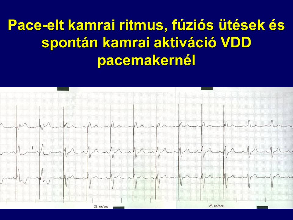 Pace-elt kamrai ritmus, fúziós ütések és spontán kamrai aktiváció VDD pacemakernél