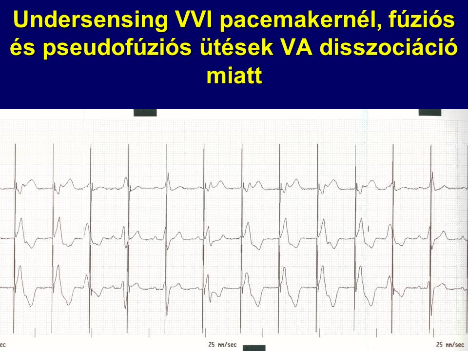 Undersensing VVI pacemakernél, fúziós és pseudofúziós ütések VA disszociáció miatt