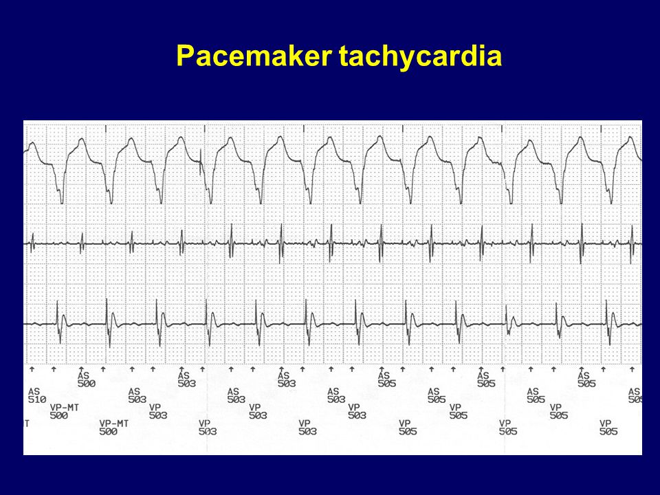 Pacemaker tachycardia