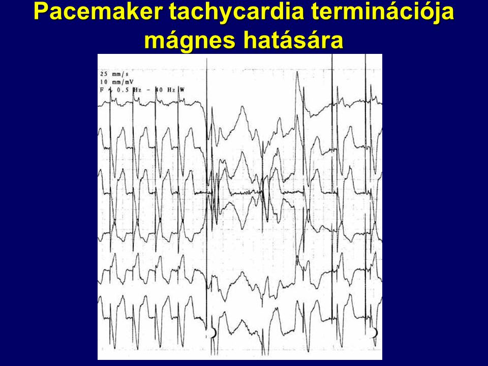 Pacemaker tachycardia terminációja mágnes hatására
