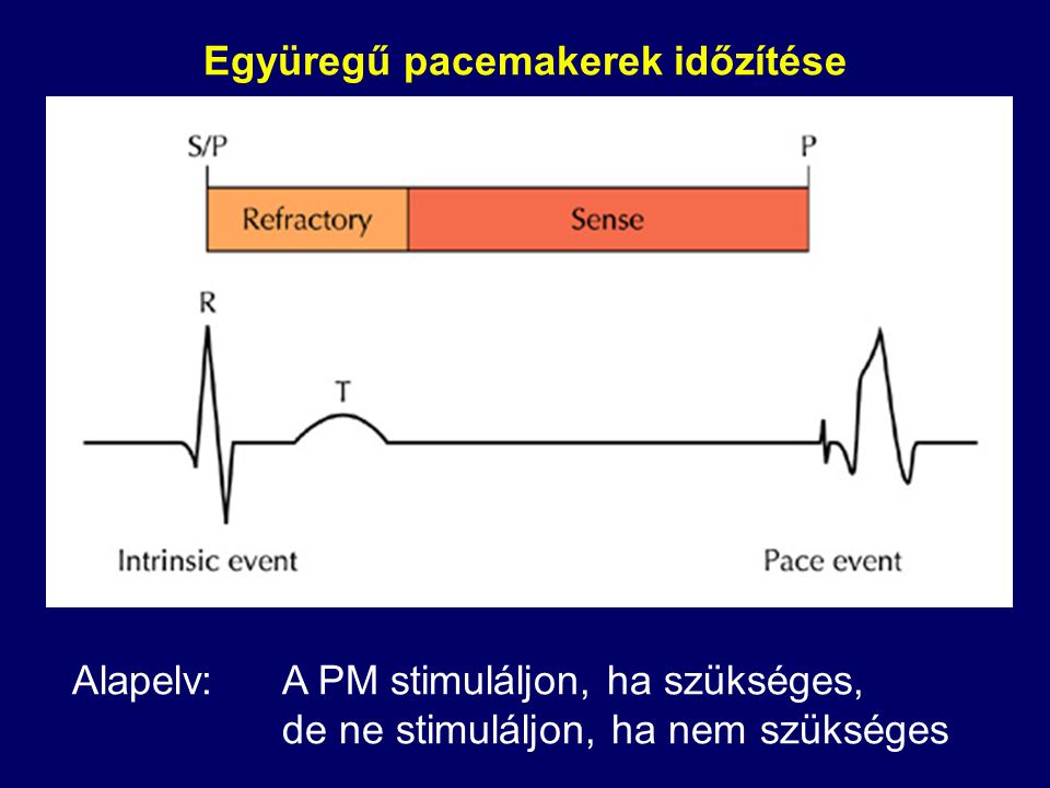 Együregű pacemakerek időzítése