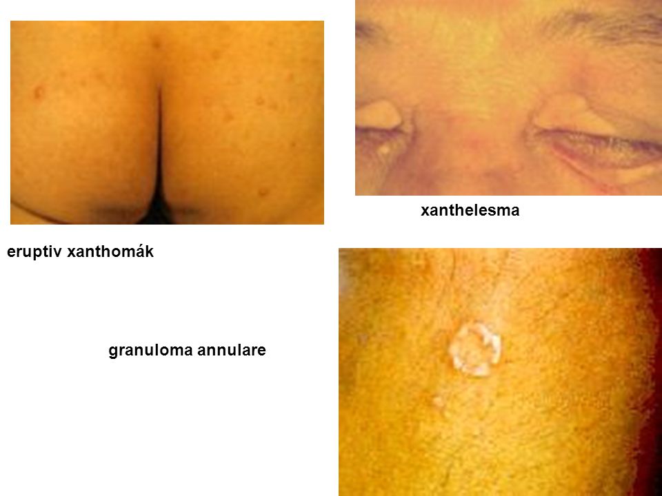 xanthelesma eruptiv xanthomák granuloma annulare