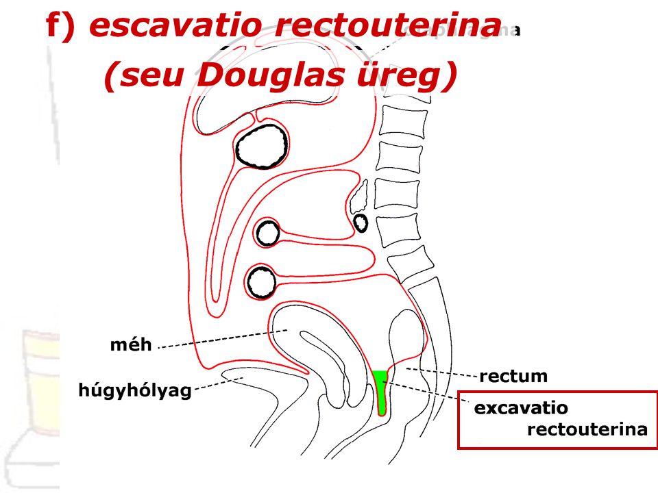 f) escavatio rectouterina