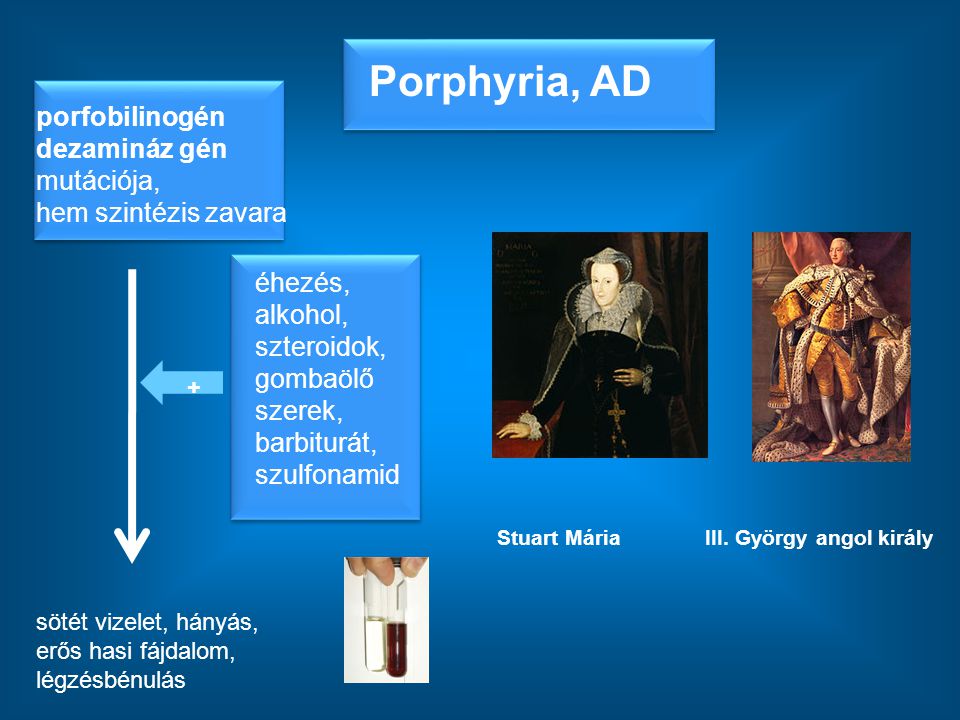 Porphyria, AD porfobilinogén dezamináz gén mutációja, hem szintézis zavara.