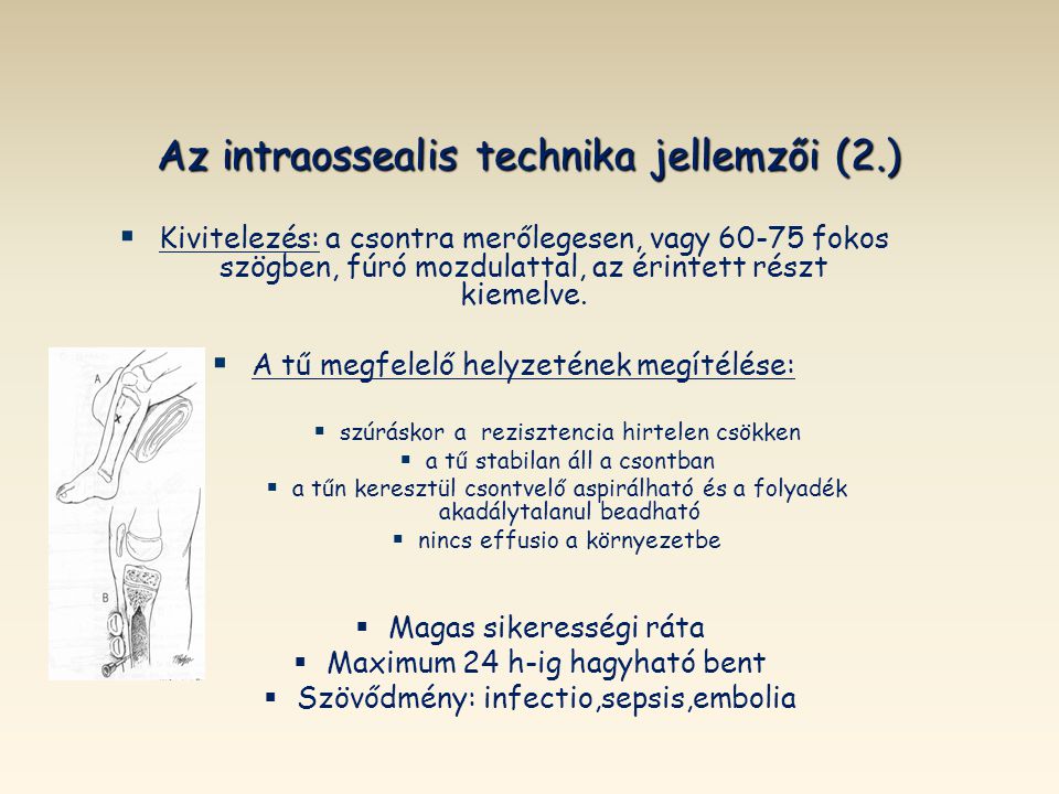 Az intraossealis technika jellemzői (2.)