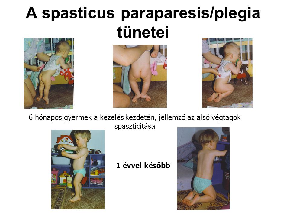 A spasticus paraparesis/plegia tünetei