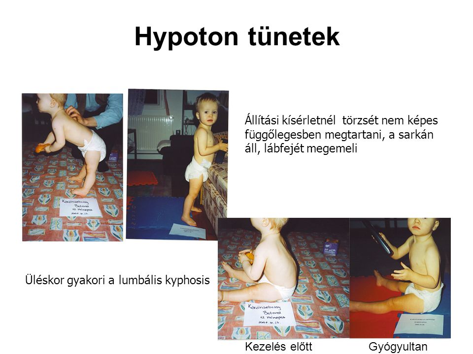 Hypoton tünetek Állítási kísérletnél törzsét nem képes függőlegesben megtartani, a sarkán áll, lábfejét megemeli.