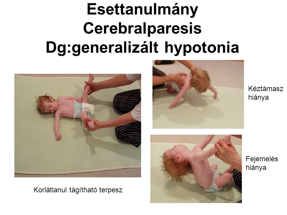 Esettanulmány Cerebralparesis Dg:generalizált hypotonia