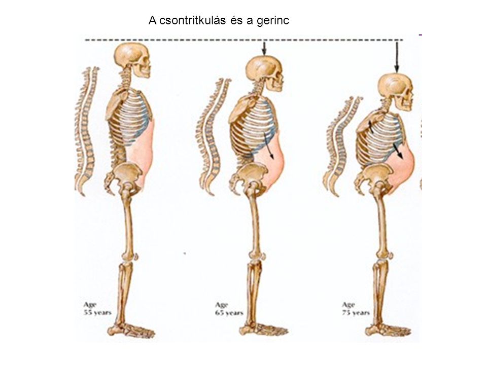 A csontritkulás és a gerinc
