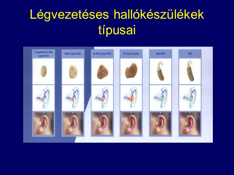 Légvezetéses hallókészülékek típusai