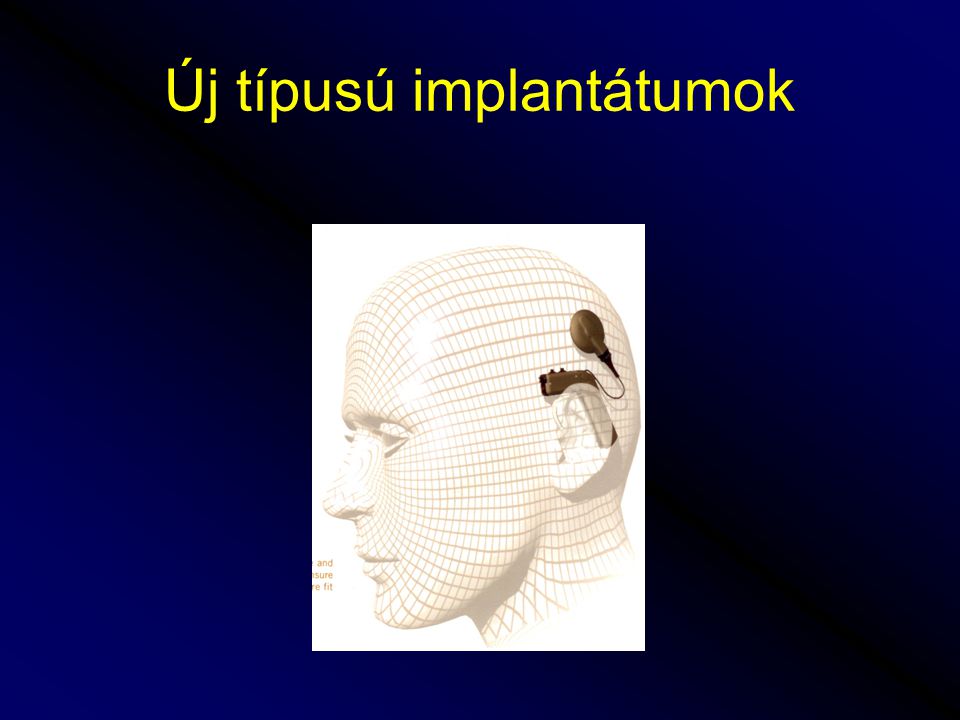 Új típusú implantátumok