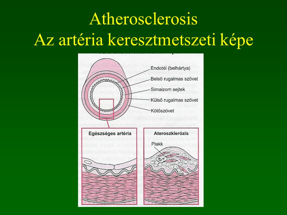 Atherosclerosis Az artéria keresztmetszeti képe