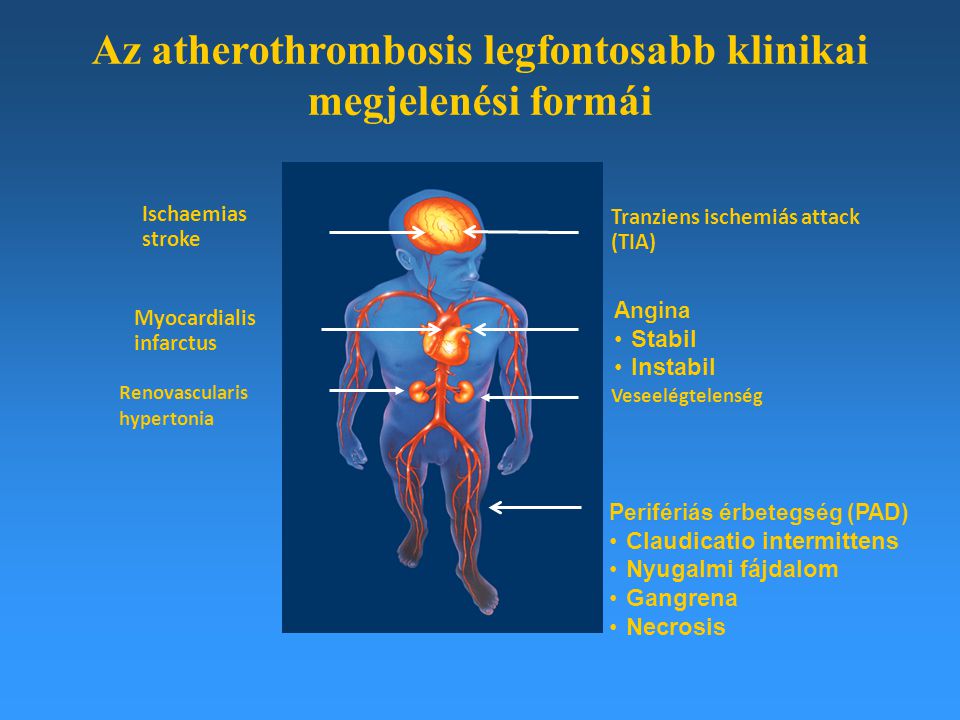 Az atherothrombosis legfontosabb klinikai megjelenési formái