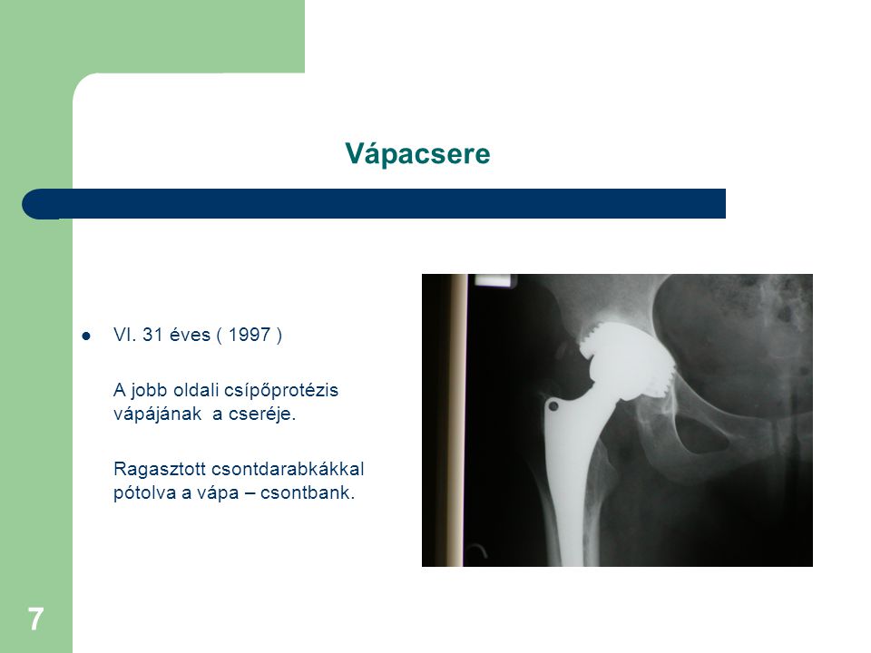 Vápacsere VI. 31 éves ( 1997 ) A jobb oldali csípőprotézis vápájának a cseréje.