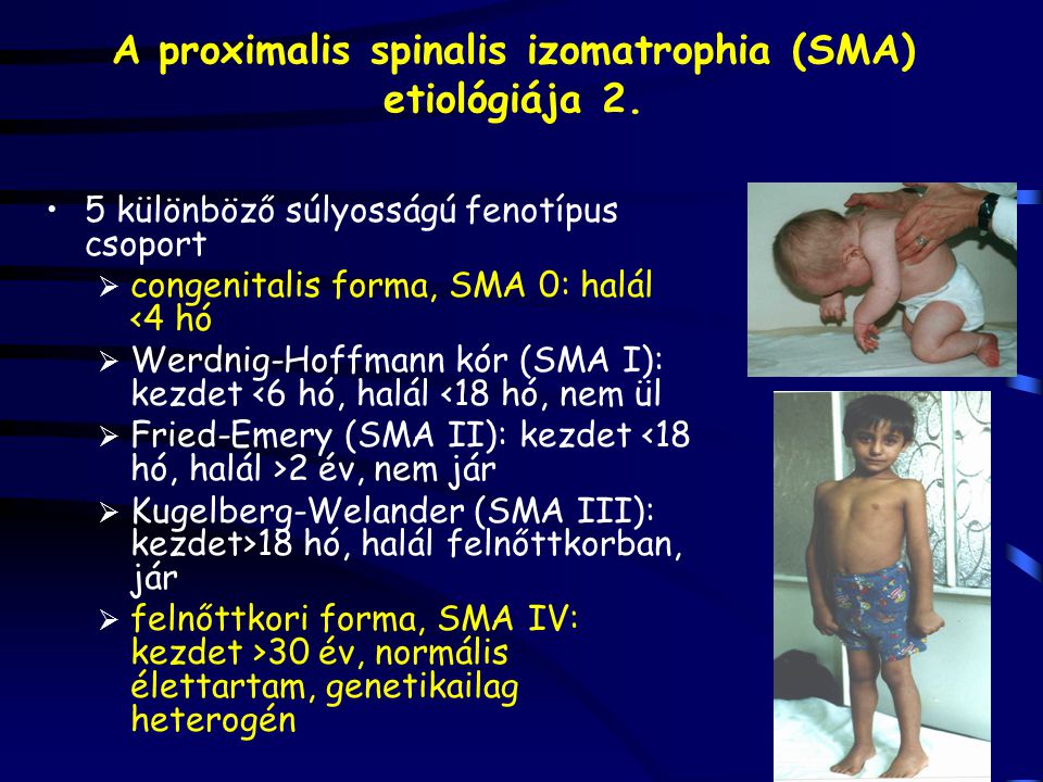 A proximalis spinalis izomatrophia (SMA) etiológiája 2.