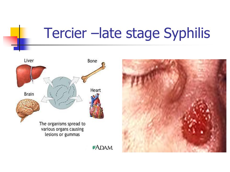 Tercier –late stage Syphilis