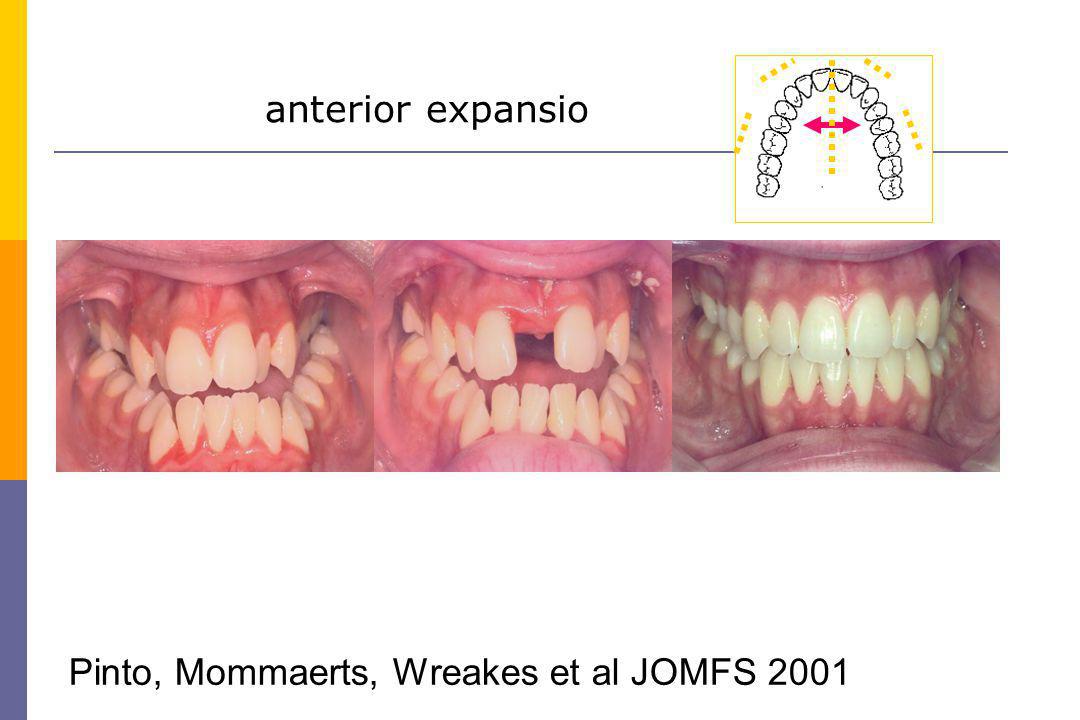 anterior expansio Pinto, Mommaerts, Wreakes et al JOMFS 2001