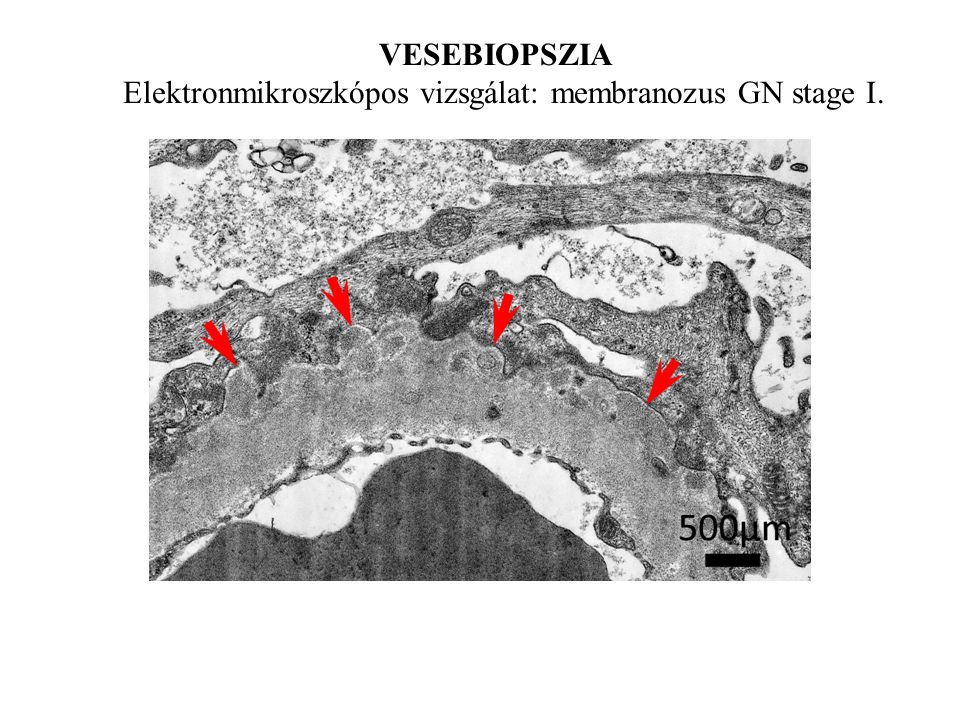 Elektronmikroszkópos vizsgálat: membranozus GN stage I.