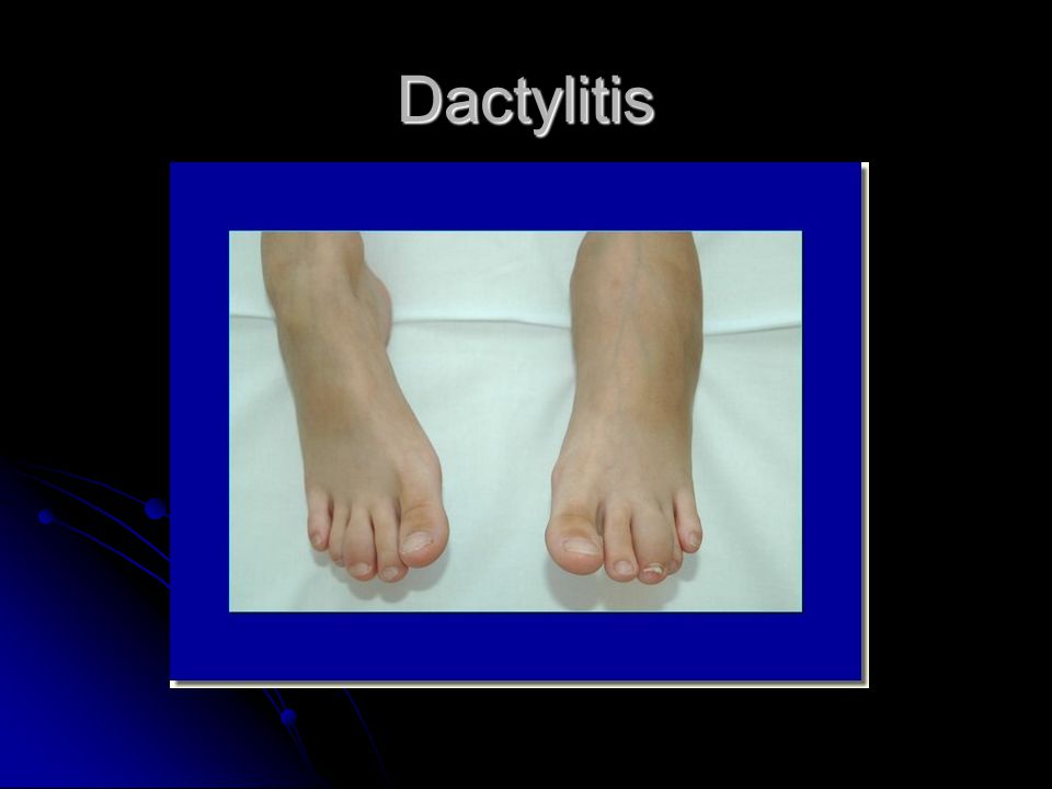 Dactylitis